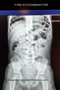 X-Ray Constipated