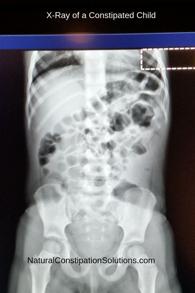 XRay Constipated child Bristol Stool Chart to help determine if you